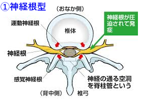 神経根型 神経根型