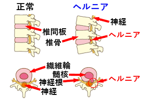 腰部椎間板ヘルニア 腰部椎間板ヘルニア